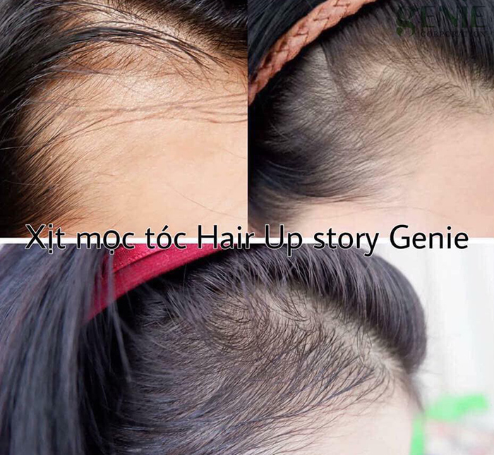 Tinh Chất Mọc Tóc Genie Hair Up Story Paris Choi Cao Cấp Hàn Quốc